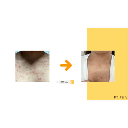 Dr. Tisha AC7 Анти акне серум с микроигли 3 х 1 g