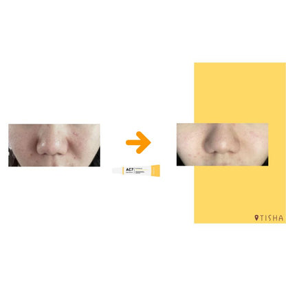 Dr. Tisha AC7 Анти акне серум с микроигли 3 х 1 g