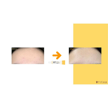 Dr. Tisha AC7 Анти акне серум с микроигли 3 х 1 g