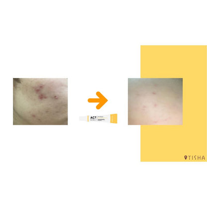 Dr. Tisha AC7 Анти акне серум с микроигли 3 х 1 g