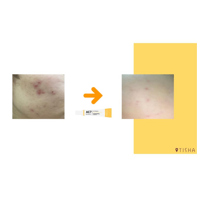 Dr. Tisha AC7 Анти акне серум с микроигли 3 х 1 g