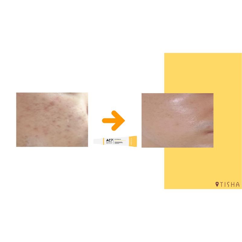 Dr. Tisha AC7 Анти акне серум с микроигли 3 х 1 g