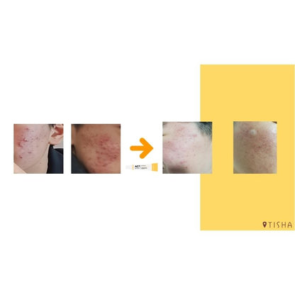 Dr. Tisha AC7 Анти акне серум с микроигли 3 х 1 g