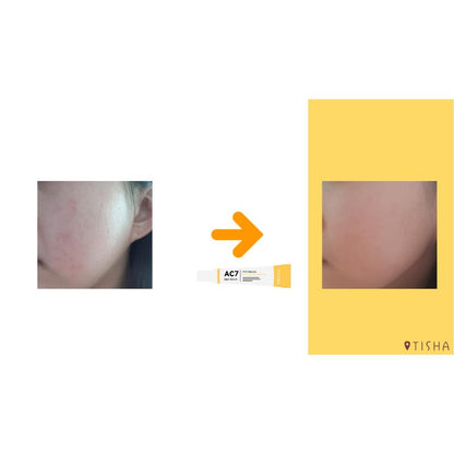 Dr. Tisha AC7 Анти акне серум с микроигли 3 х 1 g