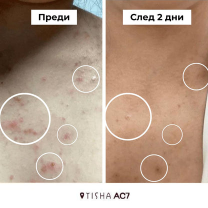 Dr. Tisha AC7 Анти акне серум с микроигли (спикули)