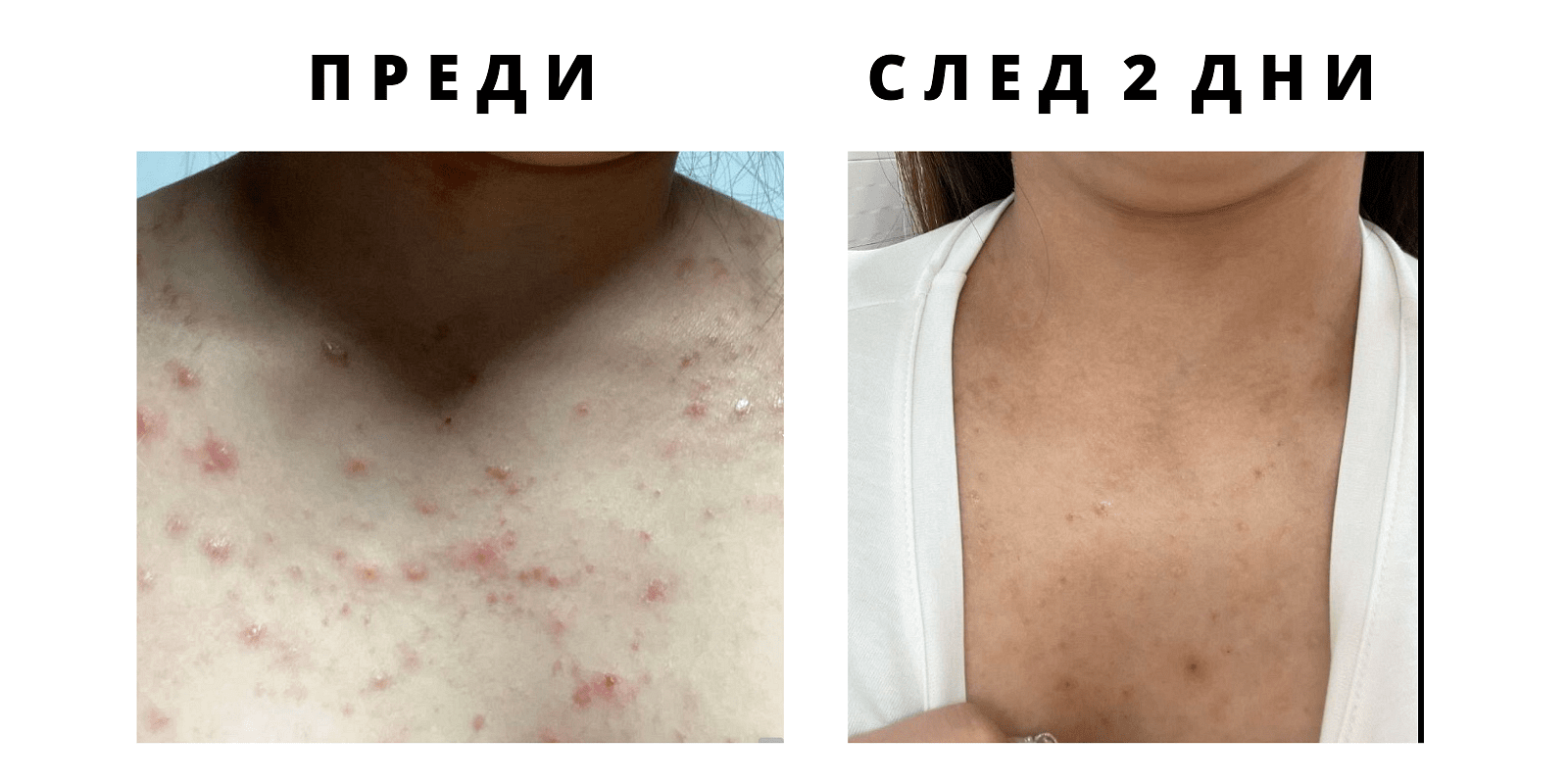 Dr. Tisha AC7 Анти акне серум с микроигли