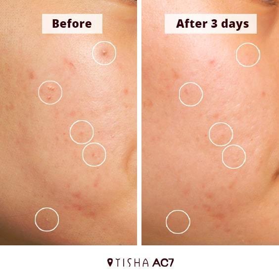 Dr. Tisha AC7 Анти акне серум с микроигли