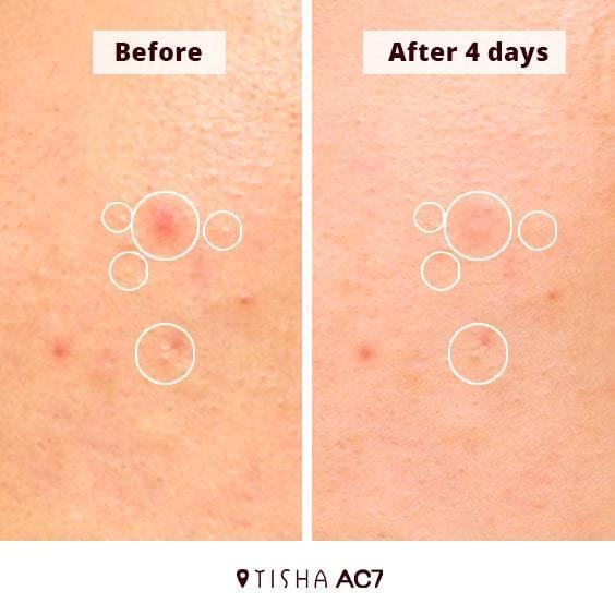 Dr. Tisha AC7 Анти акне серум с микроигли