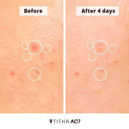 Dr. Tisha AC7 Анти акне серум с микроигли