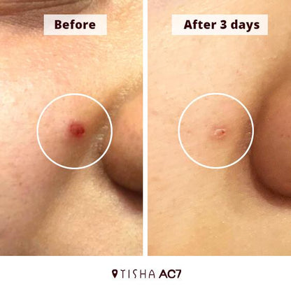 Dr. Tisha AC7 Анти акне серум с микроигли (спикули)